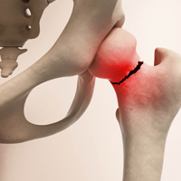 שבר אוסטיאופורוטי-נקודת מפנה בטיפול בחולה